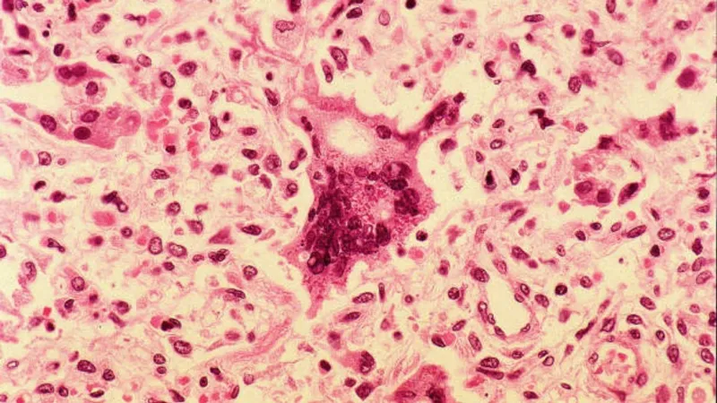 Measles cases approach 1K as state reports 5th 'measles-associated' death