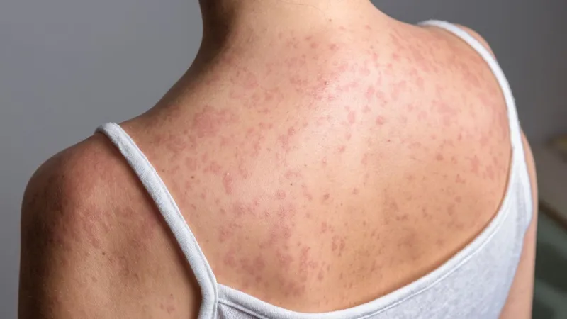 SCDPH reports measles case in the Lowcountry