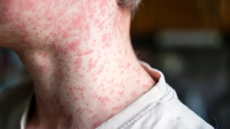 DPH reports a second measles case in the Lowcountry this month