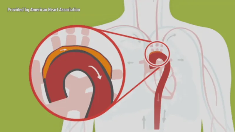MUSC expert explains aortic dissection after Sen. Lindsey Graham's cause of death released