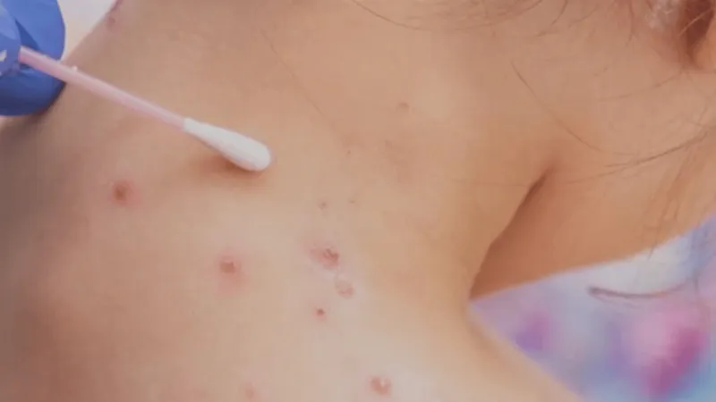 Lower vaccination rates cited as Florida ranks fifth nationwide for measles cases