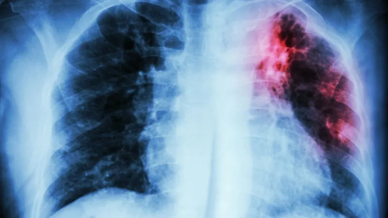 State health officials probe tuberculosis exposure at Summerville High School