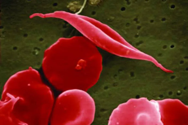 SCDPH encourages people impacted by sickle to choose healthy habits