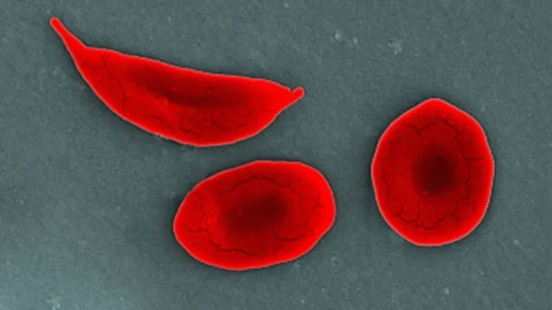 Sickle cell awareness month highlights those with sickle cell disease, how to stay healthy