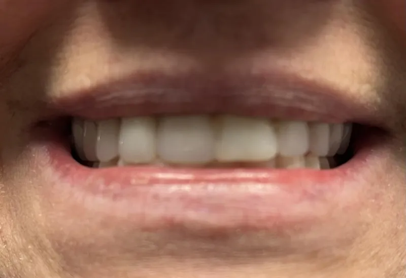 Turns Out, Teeth Can Get Bruised Too