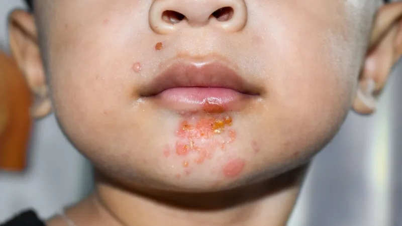 Northside ISD reports up to 14 possible impetigo cases among O'Connor High School athletes