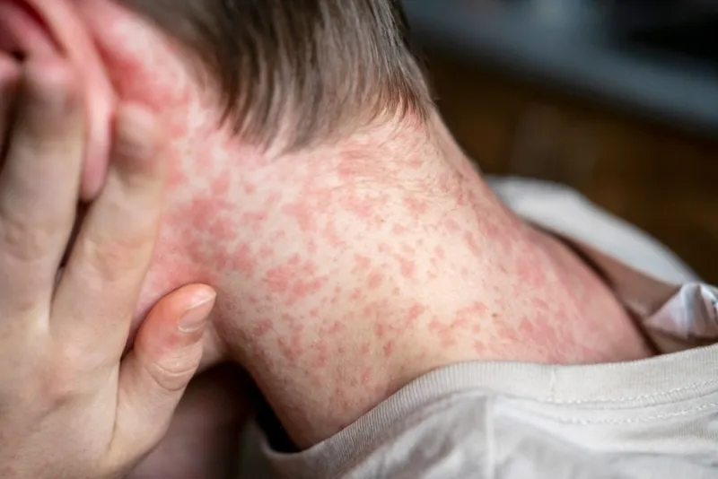 Measles outbreak declared following latest Teton County case