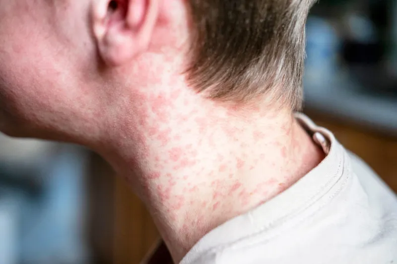 Six cases of measles confirmed by Wyoming Department of Health